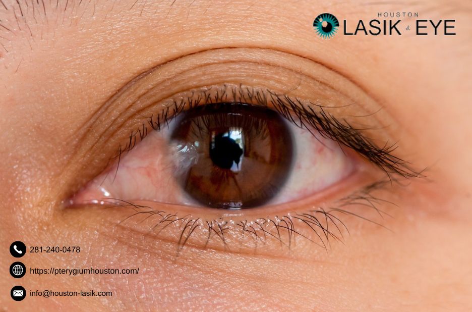 Practical guide to pterygium treatment and recovery Practical guide to pterygium treatment and recovery