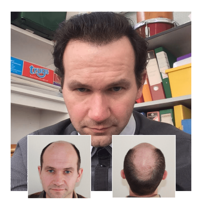 Regain Confidence: A Friendly Guide to Replacing Lost Hair Regain Confidence: A Friendly Guide to Replacing Lost Hair